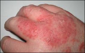 Pengobatan Alami Mengobati Dermatitis